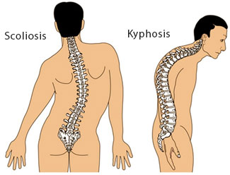 Postural defects - Scoliosis - Kyphosis